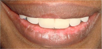 6 dental crowns to repair badly broken down teeth after 328052