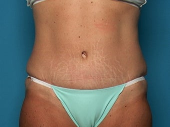 Abdominoplasty after 134581