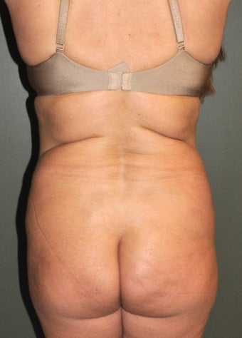 Body Liposuction after 520941