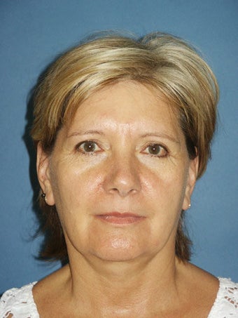 Facelift, Upper and Lower Blepharoplasty with Periorbital Chemical Peel, Chin Augmentation and Lip Augmentation before 249141