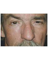 Sskin cancer reconstruction on the cheek after 84499