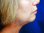 Neck Lift before 87074
