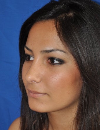 Rhinoplasty after 373763