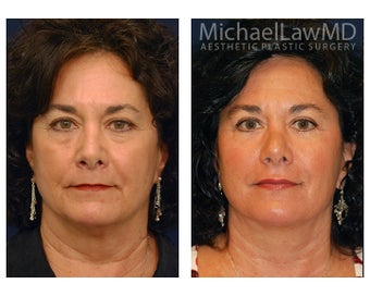 Facial Rejuvenation - Lower Face Lift before 395206