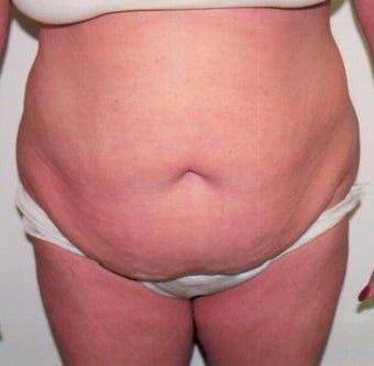 Lipo-Abdominoplasty before 238214