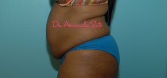 Abdominoplasty (Tummy Tuck) before 564440