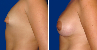 Breast Implants after 494496