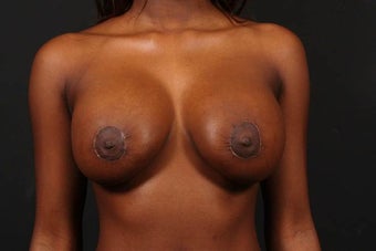 Areola reduction after 567572