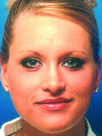 Rhinoplasty with sculpting of nasal tip and dorsum, and correction of nasal over-projection. after 249042