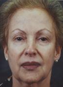 Necklift before 335680
