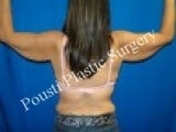 Arm Lift before 644534