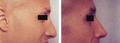 Rhinoplasty revision before 130779