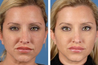 Botox Cosmetic & Restylane after 356613