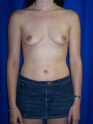 Breast Augmentation Surgery before 162010