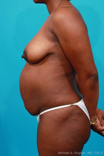 Mommy Makeover: Breast Lift & Extended Abdominoplasty before 252327