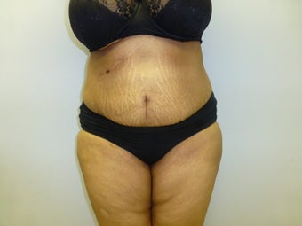 Mini Tummy Tuck and liposuction after 590774