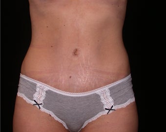Tummy tuck after 197303