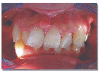 Invisalign for severe crowding/ non extraction before 310074