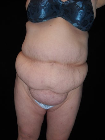 Tummy tuck (abdominoplasty) before 223315