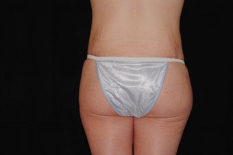 Body Lift 479774