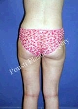 Liposuction 634648