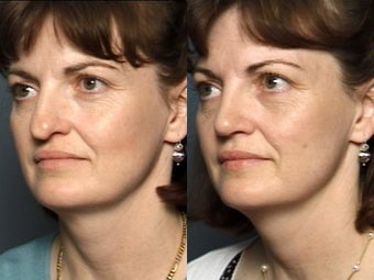 Nose Surgery after 338473