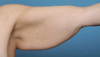 Arm Lift before 544868