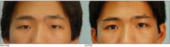 Asian Blepharoplasty ("Double Eyelid" Procedure) before 136813