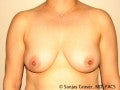 Breast Augmentation before 147527