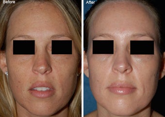 Fraxel Laser Resurfacing before 97888