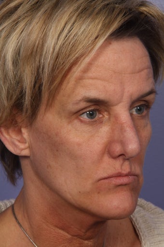 Botox before 333882
