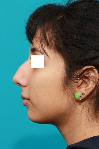 Closed Rhinoplasty before 134616
