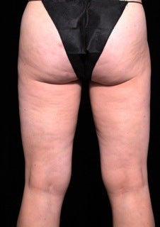 Cellulaze 614469