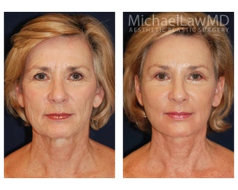 Facial Rejuvenation after 395153