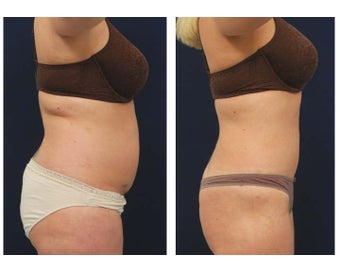 Liposuction 397041