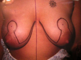 Breast Reduction before 166273