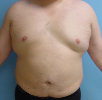 Male liposuction/liposculpture after 314976