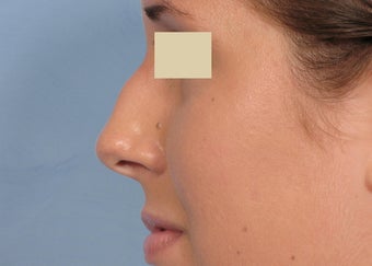 Rhinoplasty before 112966