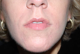 Nasal labial folds treatment with Evolence after 102459