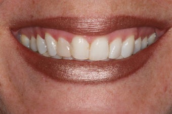 Minimal Prep Veneers/ Gum LIft before 194542