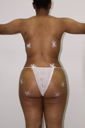 Brazilian Butt Lift after 598213
