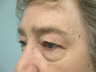 Upper and Lower Lid Blepharoplasty and Cheeklift before 148580