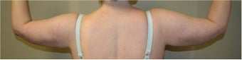 SmartLipo Arms Bilateral after 109336