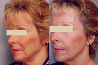 Sculptra treatments before 125334