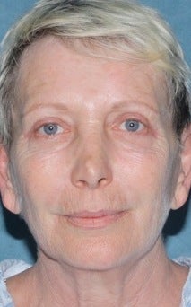 Laser resurfacing treatment for wrinkles before 376154