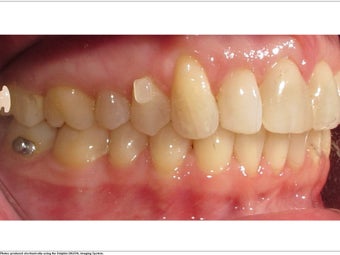 Invisalign after 362339