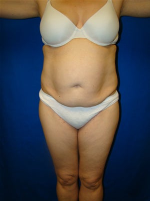 Tummy Tuck Surgery (abdominoplasty) before 127284