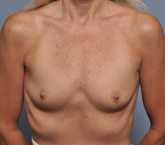 Breast Implants before 614413