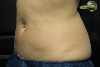 Zeltiq CoolSculpting after 300931