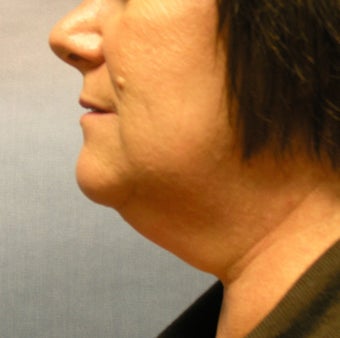 chin liposuction before 408393